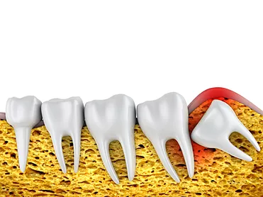 Painless & Cost-Effective Wisdom Teeth Removal In Gurgaon -