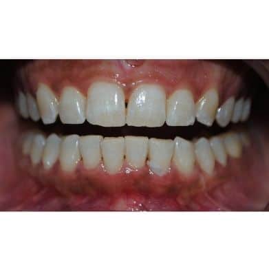 Instant Teeth Whitening / Bleaching Treatment in Gurgaon