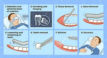 Painless & Cost-Effective Wisdom Teeth Removal In Gurgaon -